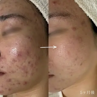 シェノン所属・ニキビ・毛穴・ フェイシャル専門店のエステ・リラクイメージ