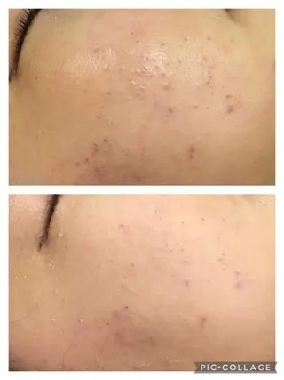 ロング カラー パーマ ヘアアレンジ メンズ キッズ ネイル マツエク・マツパ アイブロウ 🔥3か月で肌革命 🔥ニキビ専門店のエステ・リラクイメージ