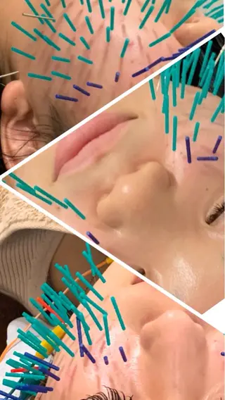 表参道鍼灸院K 美容鍼🔮ララピールのエステ・リラクイメージ