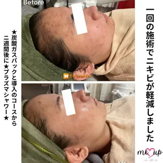 Meupニキビ専門店 背中/ハーブ/肌管理のその他イメージ