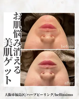 bellissimo 【ベリッシモ】所属・ちひろ　痩身/ハーブ bellissimoのエステ・リラクイメージ