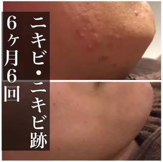 セミロング カラー パーマ ヘアアレンジ メンズ キッズ ネイル マツエク・マツパ アイブロウ 夏までに肌荒れ卒業 するサロン🌻のエステ・リラクイメージ