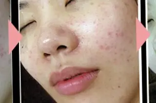 ☺ハーブピール💕 ソフィアカロン💖のエステ・リラクイメージ