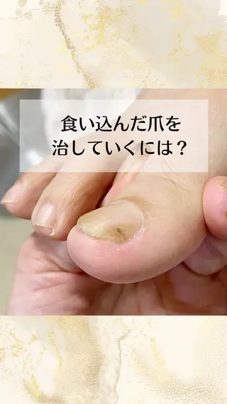 ネイル 深爪・巻き爪 専門サンセリテのネイルデザイン