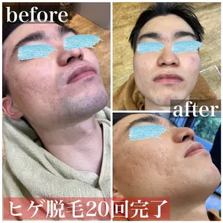 メンズ HAIRS YOSHIOKA所属・ヘアーズヨシオカ MENSヒゲ脱毛のエステ・リラクイメージ