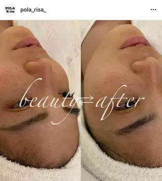 韓国/ピーリング 毛穴洗浄/POLAのエステ・リラクイメージ