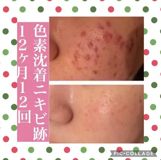 夏までに肌荒れ卒業 するサロン🌻のエステ・リラクイメージ