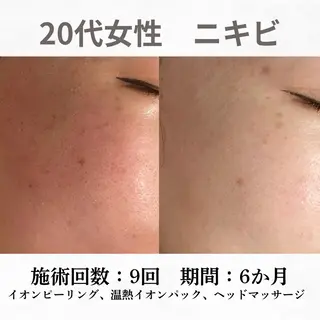 重度ニキビ専門🌷 ダウンタイムなしのエステ・リラクイメージ