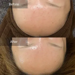 ハーブピーリング/韓国肌管理/フェイシャル/毛穴洗浄/眉毛/顔脱毛【糸脱毛専門】rev所属・ハーブピーリング🌹 毛穴洗浄❤️眉waxのエステ・リラクイメージ