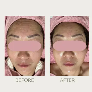 ピーリングケア 🤍moekoのエステ・リラクイメージ