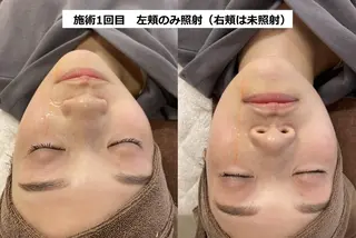 顔脱毛＆毛穴＆ニキビ 優良№1♪ヒロコ♪のエステ・リラクイメージ