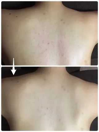 ハーブピーリング/韓国肌管理/フェイシャル/毛穴洗浄/眉毛/顔脱毛【糸脱毛専門】rev所属・ハーブピーリング🌹 毛穴洗浄❤️眉waxのエステ・リラクイメージ