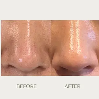 ピーリングケア 🤍moekoのエステ・リラクイメージ