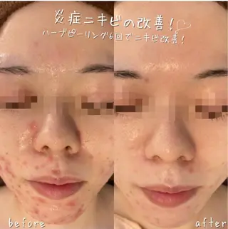 安心の看護師施術 ニキビ改善HAONのエステ・リラクイメージ