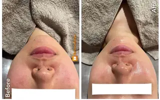 Meupニキビ専門店 背中/ハーブ/肌管理のその他イメージ