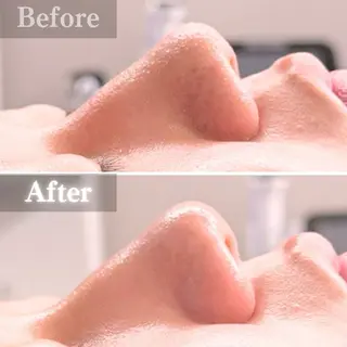 毛穴洗浄特化🫧 オオツカのエステ・リラクイメージ