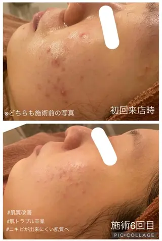 🔥3か月で肌革命 🔥ニキビ専門店のエステ・リラクイメージ