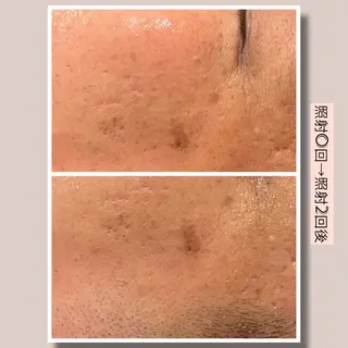 ☆痩身/小顔☆ ハイパーナイフexのエステ・リラクイメージ