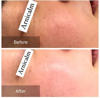 ハーブピーリング 肌再生ピーリング/のエステ・リラクイメージ