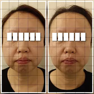 水光肌ピーリング ハーブピーリングのエステ・リラクイメージ