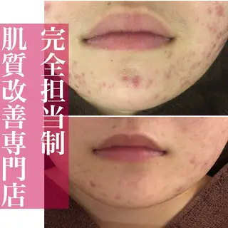 学生ニキビ改善🍀 優しい肌質改善のエステ・リラクイメージ