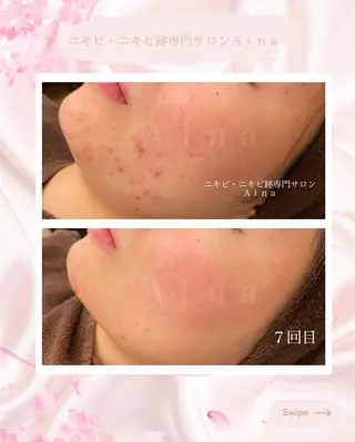 ニキビ跡専門サロン Ａｉｎａのエステ・リラクイメージ