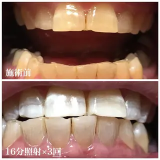 ネイル/耳つぼ /新ホワイトニングのネイルデザイン