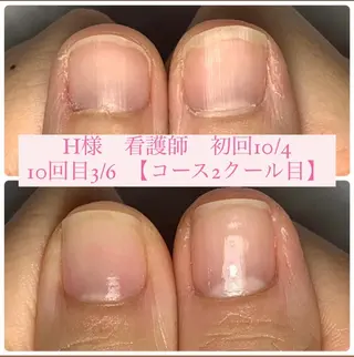 ネイル 自爪育成/深爪矯正 mikiのネイルデザイン