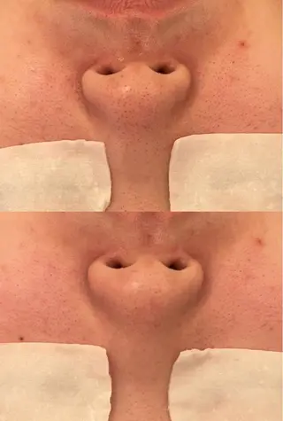 毛穴ケア/毛穴診断/ 毛穴洗浄〔心斎橋〕のエステ・リラクイメージ