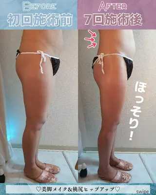 痩身ハーブピーリング 筋膜リリース☆B&Hのエステ・リラクイメージ