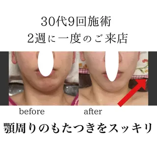 オアシス・さくら所属・小顔（シミ ニキビ）脱毛サロンのエステ・リラクイメージ