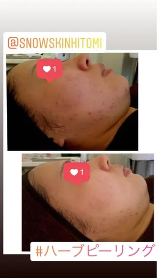 ニキビ/肌質改善専門 Snow skinのエステ・リラクイメージ