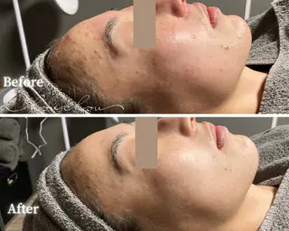 beauty & health salon Chou chou所属・ニキビ・毛穴🌿肌を 育てるララピール✨のエステ・リラクイメージ