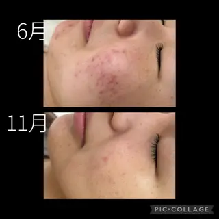 DeI'm柴田所属・【肌質改善サロン】 Harunaのネイルデザイン