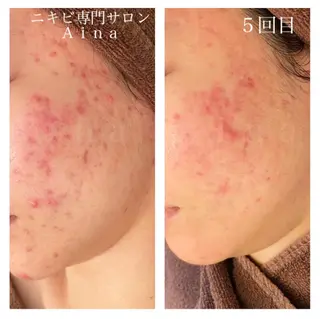 ミディアム カラー パーマ ヘアアレンジ メンズ キッズ ネイル マツエク・マツパ ニキビ跡専門サロン Ainaのエステ・リラクイメージ