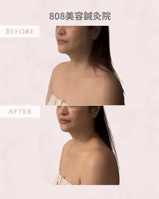 圧倒的たるみ改善 美容鍼エステのエステ・リラクイメージ