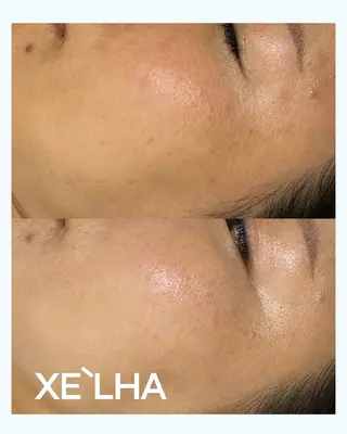 毛穴ケア くすみ肌 ハーブピーリングのエステ・リラクイメージ