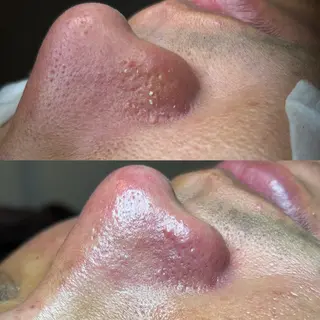 セルフエステエンリケ明石大久保店所属・夕希 毛穴と脱毛特化サロンのエステ・リラクイメージ