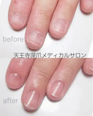 ネイル 天王寺 深爪メディカルサロンのネイルデザイン