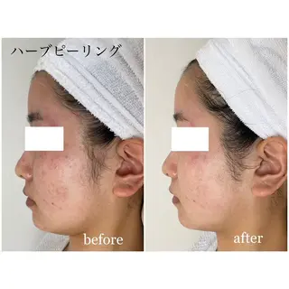 I'm -ｲﾑ-所属・肌質改善／ブライダル I'm.-イム-のエステ・リラクイメージ