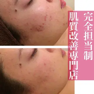 6万人の美肌実績🔥 最短ニキビ改善のエステ・リラクイメージ