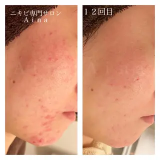 セミロング カラー パーマ ヘアアレンジ メンズ キッズ ネイル マツエク・マツパ ニキビ跡専門サロン Ainaのエステ・リラクイメージ