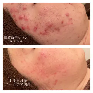 セミロング カラー パーマ ヘアアレンジ メンズ キッズ ネイル マツエク・マツパ ニキビ跡専門サロン Ainaのエステ・リラクイメージ