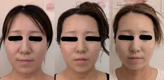 レチノール/ニキビ/ 毛穴ケア 浅川のエステ・リラクイメージ