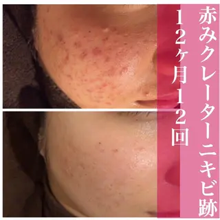 🔥3か月で肌革命 🔥ニキビ専門店のエステ・リラクイメージ