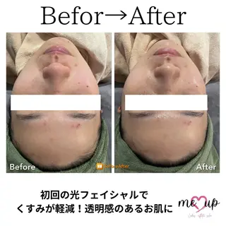 Meupニキビ専門店 背中/ハーブ/肌管理のその他イメージ