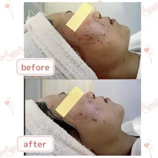 ニキビケア◇ニキビ跡 レゾン京橋店　八崎のエステ・リラクイメージ