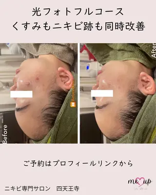 Meupニキビ専門店 背中/ハーブ/肌管理のその他イメージ