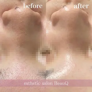 肌質改善/ブライダル 水上百華のエステ・リラクイメージ