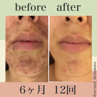 ミディアム カラー パーマ ヘアアレンジ メンズ キッズ ネイル マツエク・マツパ ニキビ・肌質改善専門 ♡人生が変わるサロンのエステ・リラクイメージ